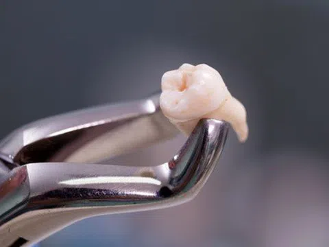 Người phụ nữ tại Trung Quốc tử vong sau khi nhổ 20 chiếc răng
