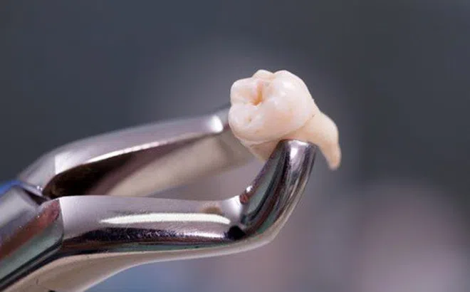 Người phụ nữ tại Trung Quốc tử vong sau khi nhổ 20 chiếc răng